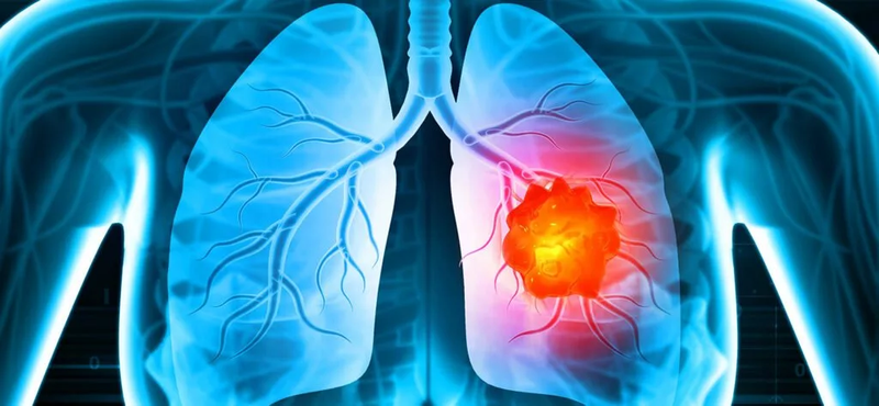 no-one-would-believe-me-when-i-suspected-i-had-lung-cancer-0923-new-1024x474.jpg.webp